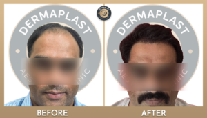 Hair Transplant in Panvel