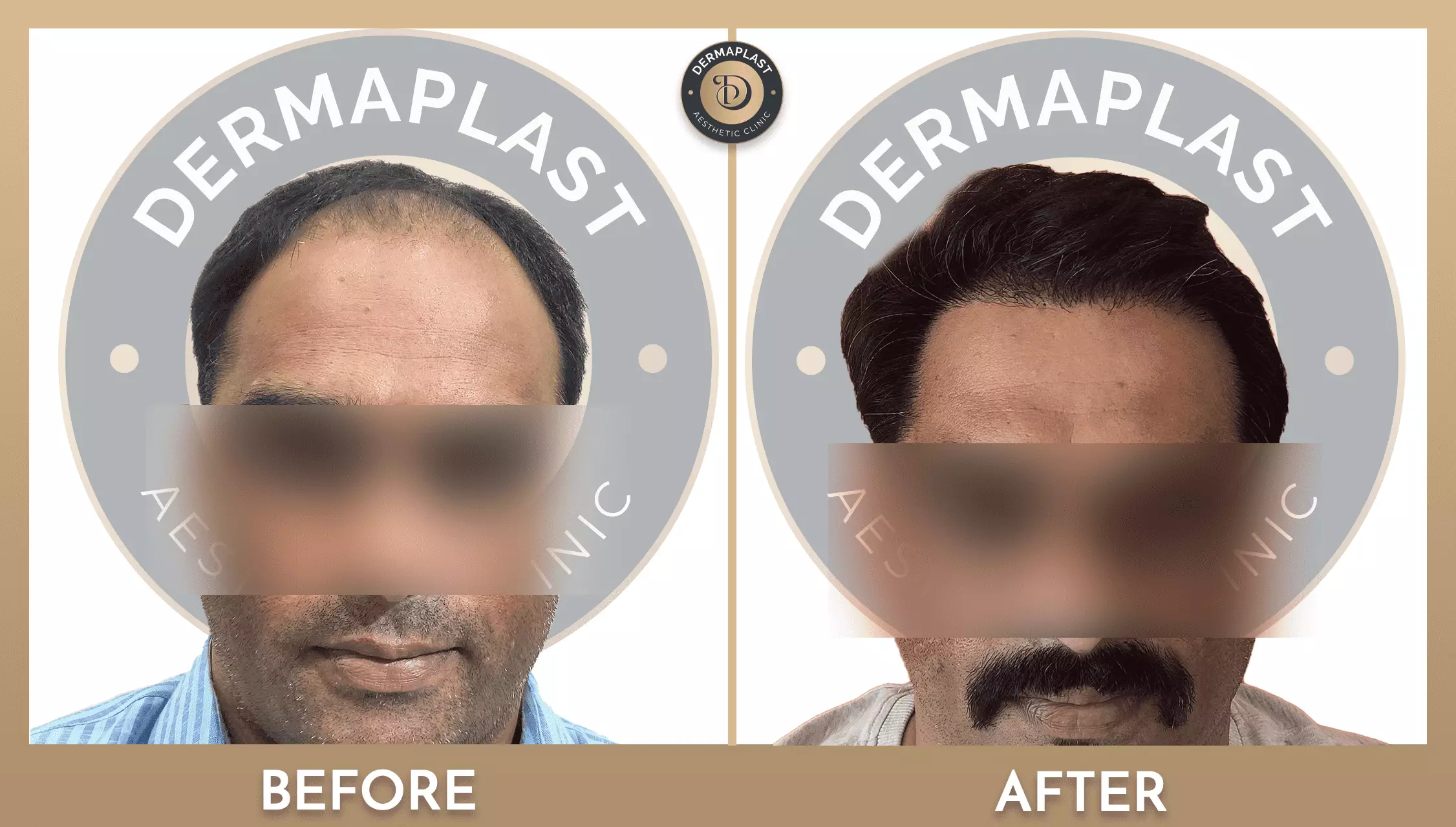 Hair Transplant in Panvel