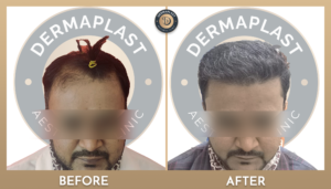 Hair Transplant in Panvel