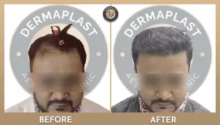 Hair Transplant in Panvel