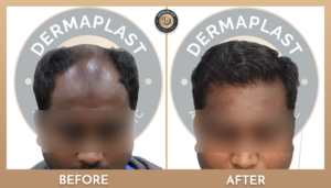 Hair Transplant in Panvel