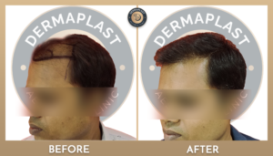 Hair Transplant in Panvel