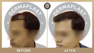 Hair Transplant in Panvel