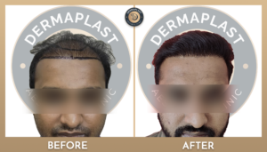 Hair Transplant in Panvel