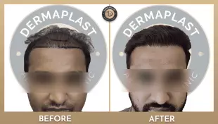 Hair Transplant in Panvel