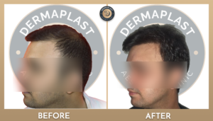 Hair Transplant in Panvel