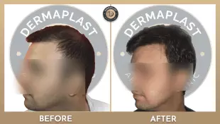 Hair Transplant in Panvel