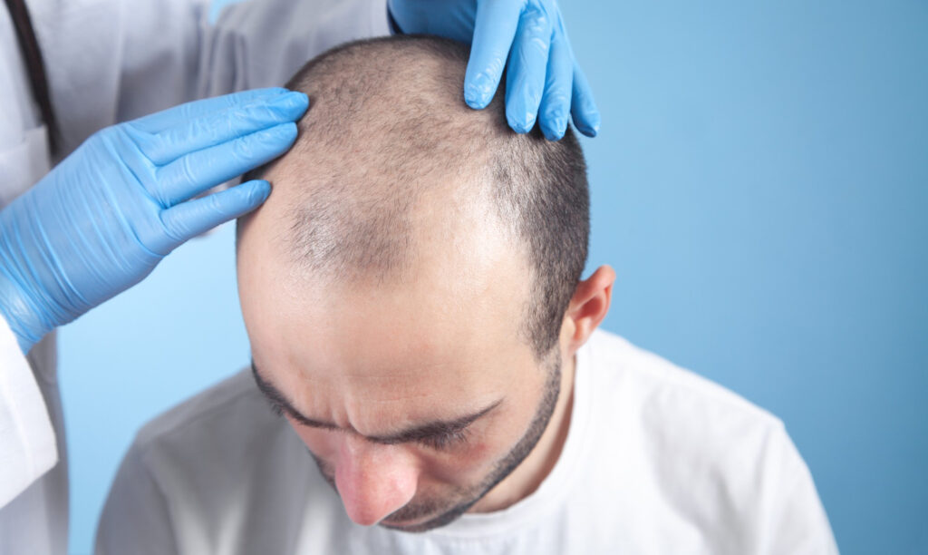 Best Hair Loss Treatment In Panvel | Hair Transplant Panvel￼