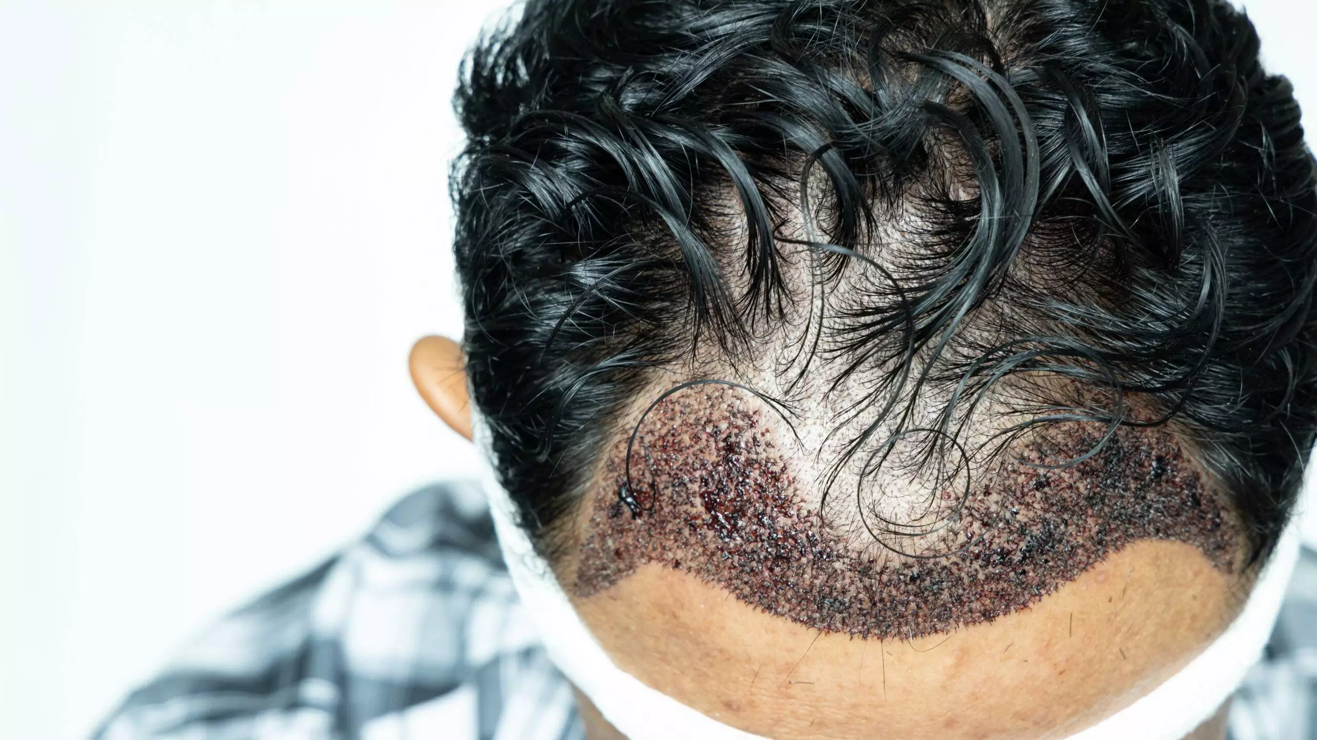 Man head with hair transplant surgery with receding hair line