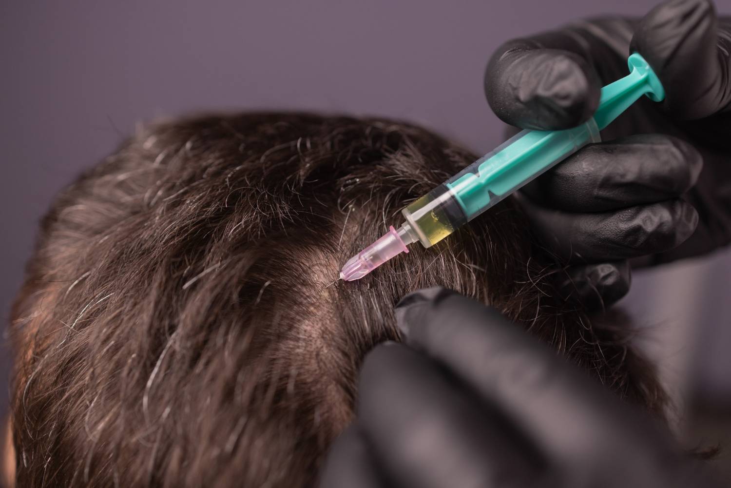 mesotherapy-hair-attractive-man-receiving-injections-his-head-man-having-mesotherapy-session-beauty-salon-therapist-protective-glove-with-syringe