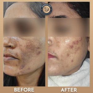 Acne Scar Treatment
