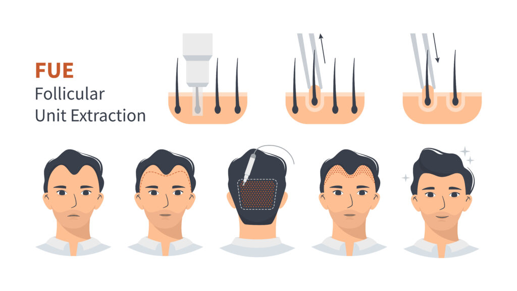 Fue hair transplant in panvel