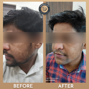 Skin Whitening treatment