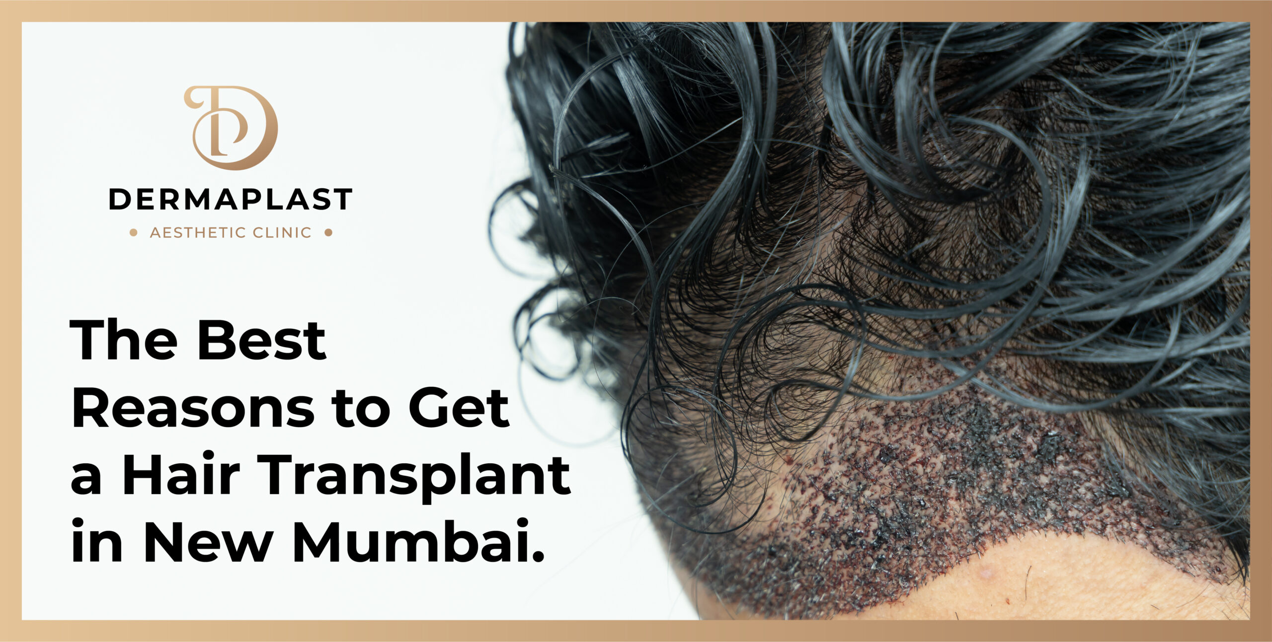 The Best Reasons to Get a Hair Transplant in New Mumbai
