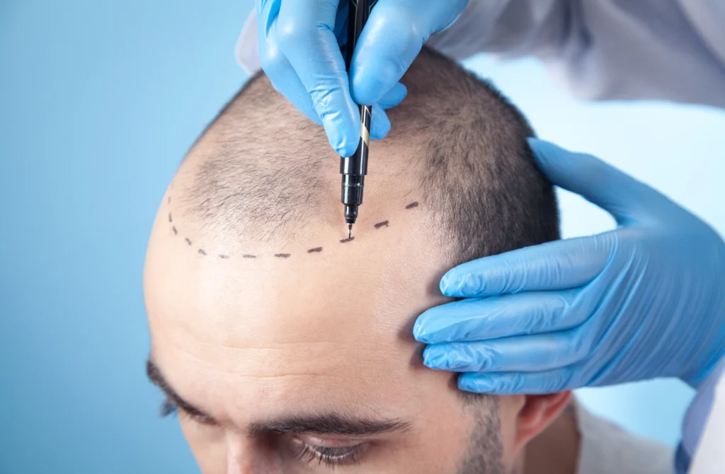 Hair Transplant Surgeon's Expertise in Panvel