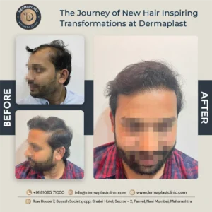 before and after hair transplant