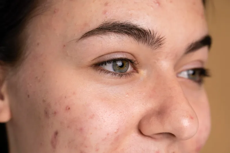 Dark Spots and Hyperpigmentation