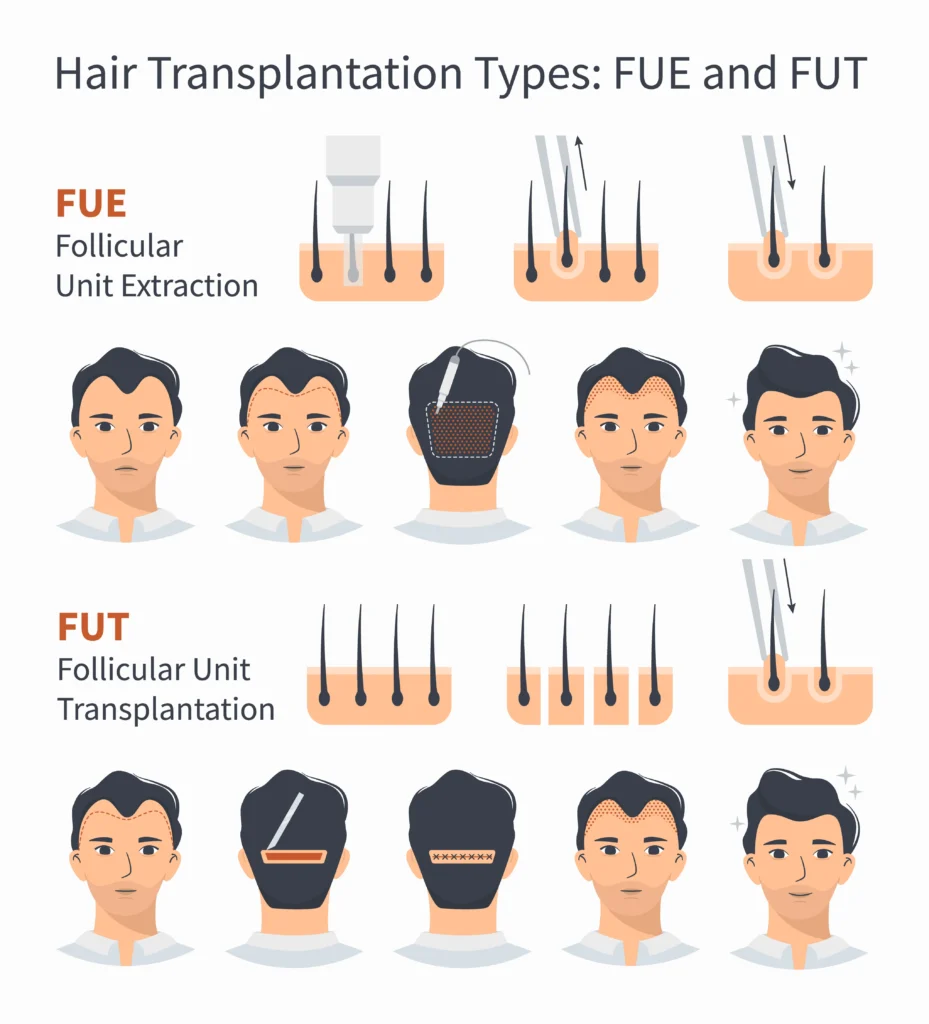 The Benefits of Hair Transplant on EMI