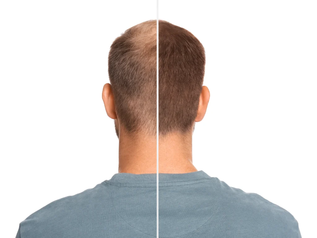 Hair Transplant Results