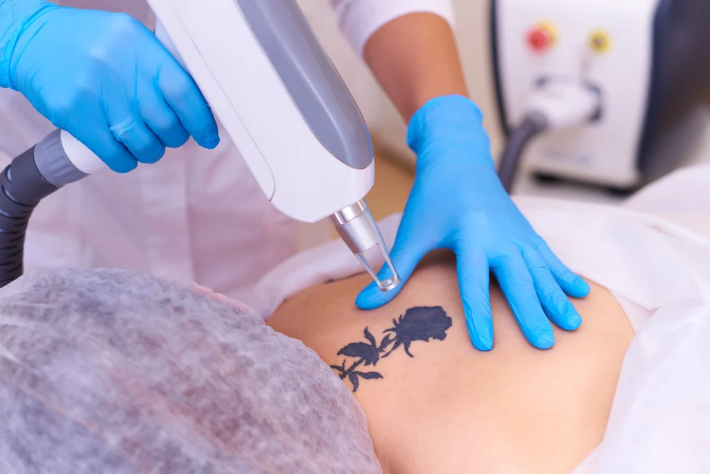 A image for the Laser Tattoo Removal Process in tattoo removal in Mumbai clinic