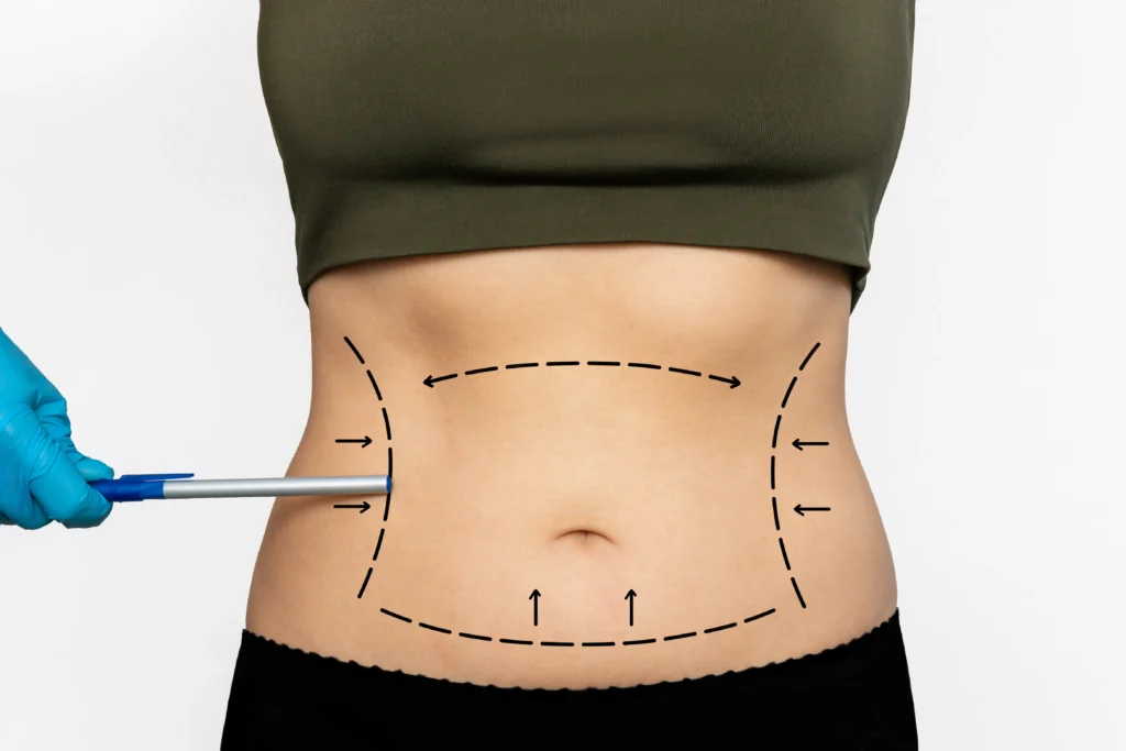 Image for Popular Liposuction Cosmetic Surgery Procedures