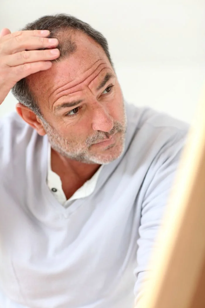 Brittle Bone Medication Can Help Your Baldness