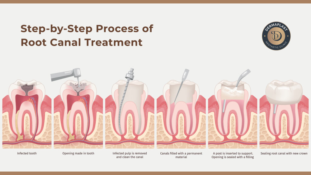 Step-by-Step Process of Root Canal Treatment