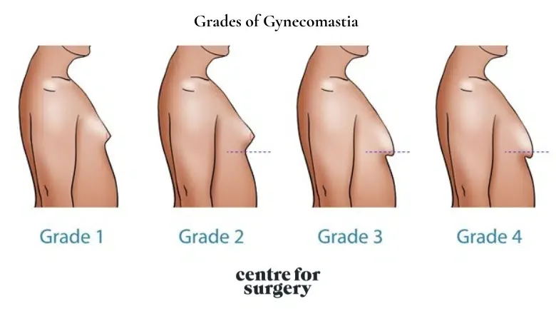 Different-Grades-of-Gynecomastia-1.png