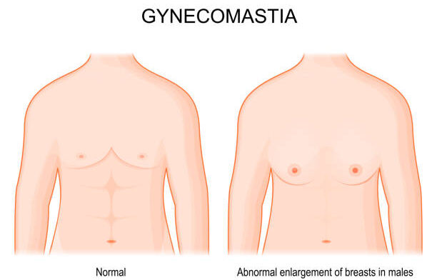 Gynecomastia. comparison and difference between normal breast and Abnormal enlargement of breasts in males. Human chest in front view. hormone imbalance between estrogens and androgens. Vector poster.