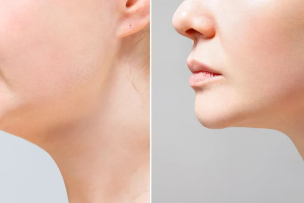 close-portrait-aged-woman-before-after-facial-rejuvenation-procedure-correction-chin-shape-liposuction-neck-result-procedure-clinic-aesthetic-medicine (1)