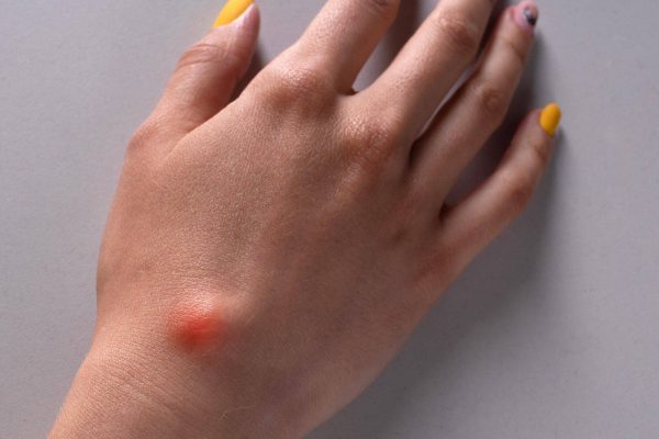 ganglion-cyst-woman-hand-white-background-min